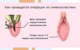 Гименопластика: что это за процедура?
