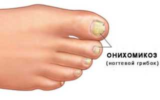 Лечение грибка на ногтях на ногах народными средствами
