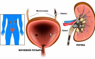 Аморфные кристаллы в моче что это