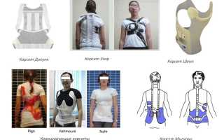 Носить ли корсет при сколиозе — мнения врачей и пациентов