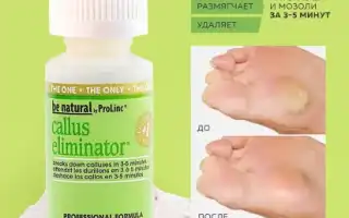 Эффективное медикаментозное лечение натоптышей на ногах