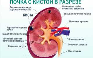 Парапельвикальные кисты почек что это такое