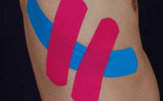 Перелом ребер — как правильно наложить повязку