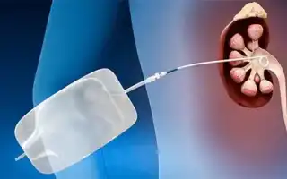 Удаление нефростомы из почки