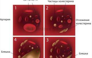 Лечение атеросклероза мозговых сосудов народными средствами