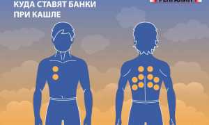 Можно ли при бронхите ставить банки