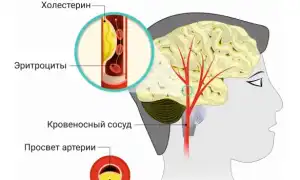 Стенозирующий атеросклероз — причины, симптомы и лечение