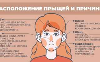Почему появляются прыщи — 9 главных причин