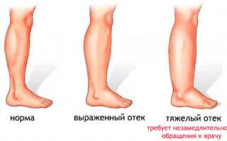 Водянка ног у женщин — причины, симптомы и лечение