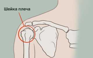 Перелом хирургической шейки плеча — фото и симптомы