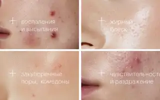 Проблемная кожа — Причины — Этапы ухода — Подбор косметики