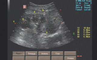 Гидрокаликоз левой почки