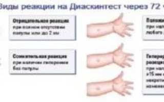 Диаскинтест можно ли делать при простуде