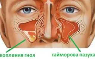 Можно ли ходить в школу с гайморитом