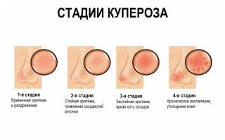 Что такое купероз: Как распознать и устранить сосудистые дефекты