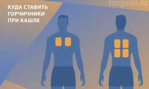 Бронхит и горчичники — можно ли использовать?