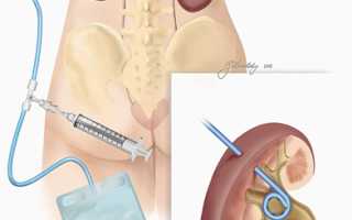Замена нефростомы