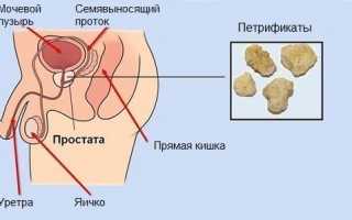 Лечение простатита у мужчин народными средствами в домашних условиях