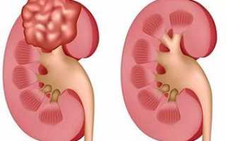 Липома в почке — что это такое?