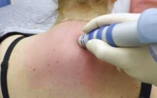 Признаки инфильтрата — что нужно знать