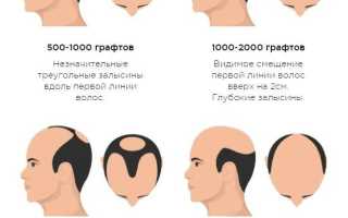 Трансплантация волос — Стоимость — Этапы