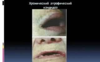 Атрофический кандидоз полости рта