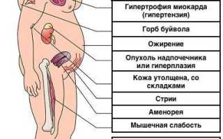 Симптомы аденомы надпочечника у женщин