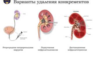 ПОДНИМАТЬ ЛИ ТЯЖЕСТИ ПРИ КАМНЯХ В ПОЧКАХ