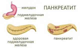 Лечение поджелудочной железы народными средствами