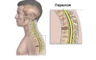 Компрессионный перелом позвонка L1 — локализация и симптомы