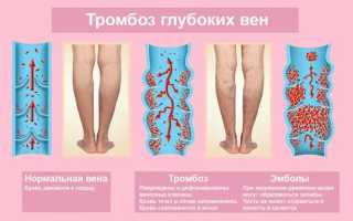 Окклюзионный тромбоз — что это и как с ним бороться