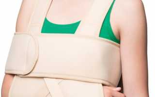 Гипсовая повязка для перелома плеча со смещением