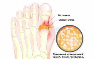 Низкий уровень мочевой кислоты у женщин — причины и последствия