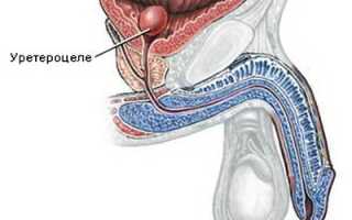 Киста мочевого пузыря у мужчин