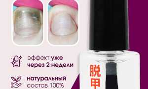 Эффективные народные средства от грибка ногтей