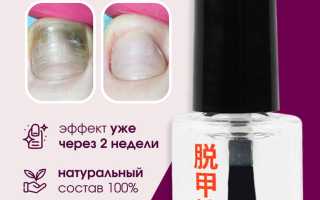 Эффективные народные средства от грибка ногтей