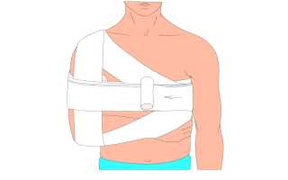 Повязка при переломе ключицы — что нужно знать