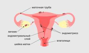 Эндометриоз у Клайры — Симптомы, Диагностика и Лечение