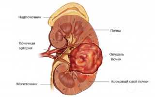 Онкоцитома почки