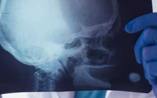 Линейный перелом затылочной кости — причины, симптомы и лечение