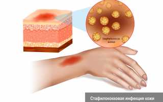 Staphylococcus haemolyticus — Особенности и Значение в Медицине