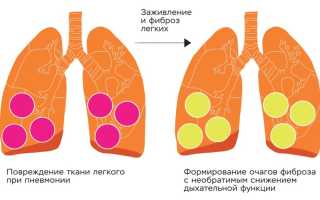 Лечение спаек в легких после пневмонии у взрослых