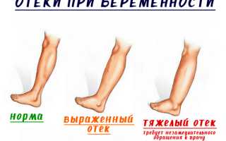 Как быстро убрать отеки на ногах в третьем триместре беременности
