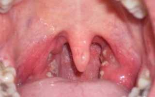 Стафилококк в горле — причины и симптомы