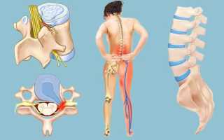 Греется ли поясница при грыже — правда и мифы