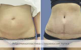 Абдоминопластика живота: Что это? И как происходит?