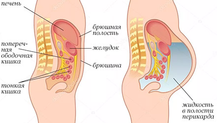 Диета для лечения водянки брюшной полости