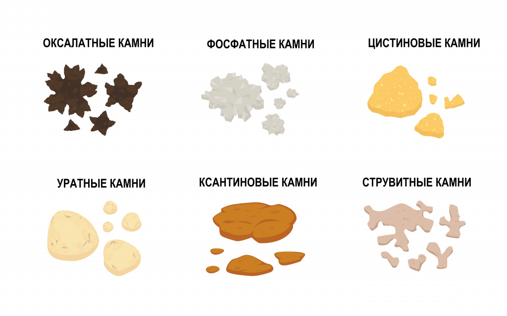 Уратные камни — причины образования и методы лечения