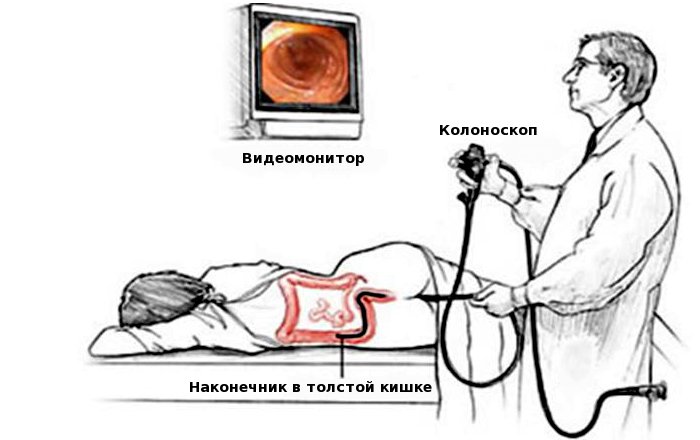Отзывы о колонотерапии кишечника — правда или миф?
