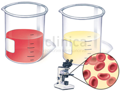 Лечение геморрагического цистита